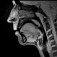 Real-time MRI of speech production at a temporal resolution of 33 m